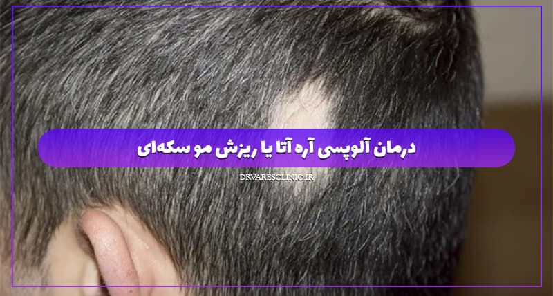 درمان آلوپسی آره آتا یا ریزش مو سکه‌ای