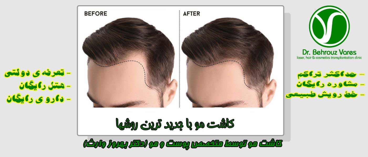 تعیین گراف مو کاشت مو بهترین کلینیک پوست مو در شیراز 